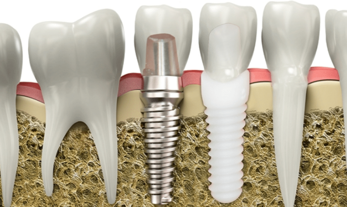 Use of Zirconia in dental implants