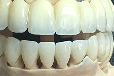 Are e.max crowns better than zirconium crowns for short teeth?