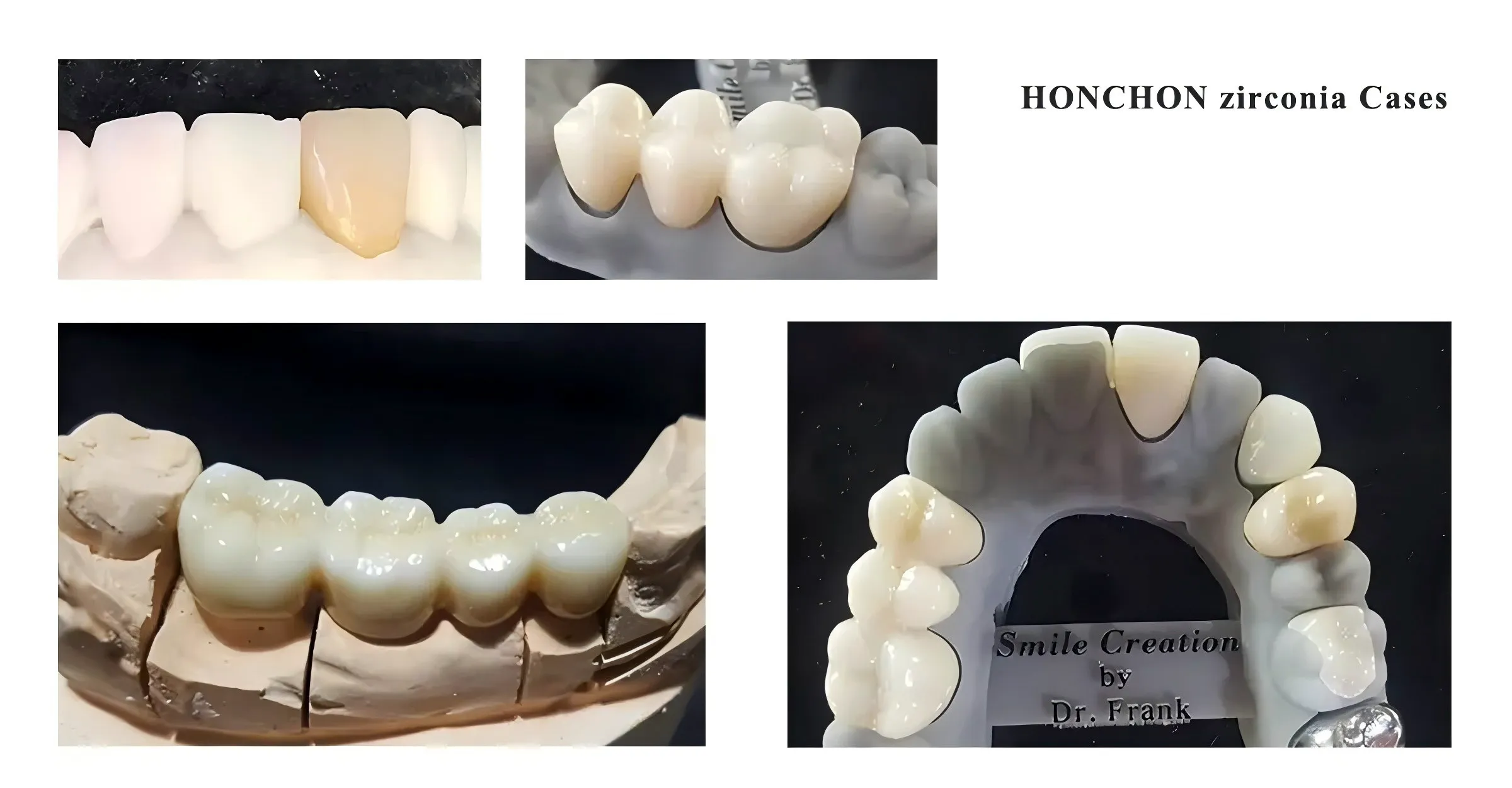 Dentures made with 3D PRO multi-layered zirconium oxide blocks for sirona