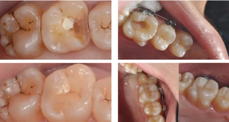 Non-Sintered Ceramic block restoration display
